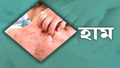 হাম ও হামের উপসর্গ নিয়ে আরও ৫ শিশুর মৃত্যু